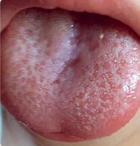 舌体胖大舌苔厚爱流口水是怎么回事
