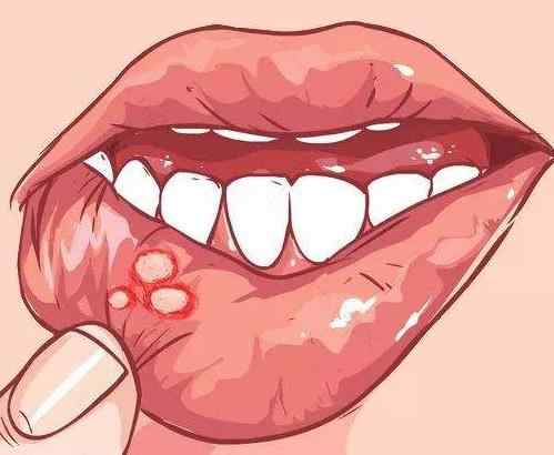 上火导致口腔溃疡 吃点藕汤即可