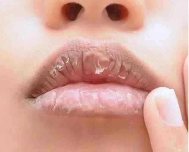 嘴唇脱皮可能和脾胃虚弱有关