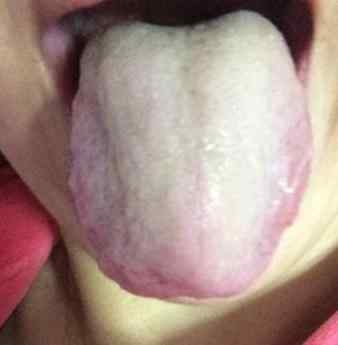 舌苔厚白口臭.jpg 舌苔厚白口臭.jpg
