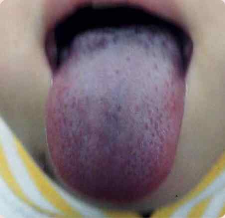 孩子口臭肚子胀舌像.jpg