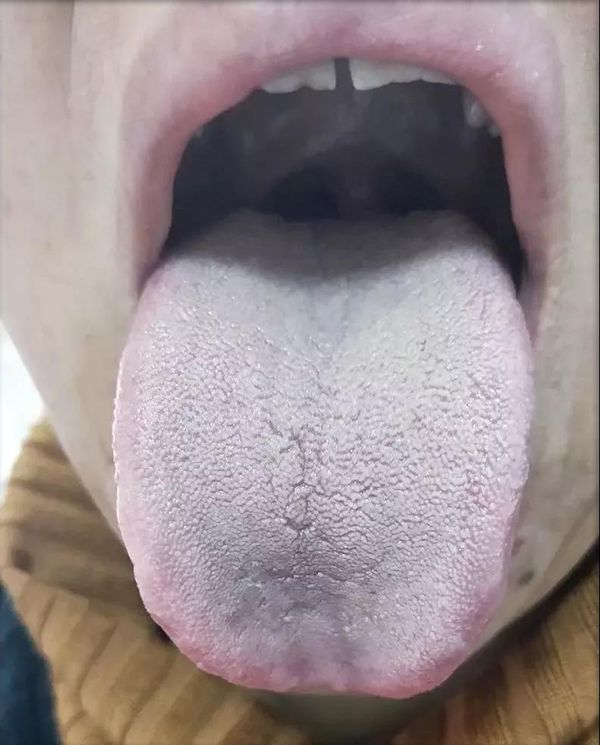 脾胃湿寒的舌头图片.jpg
