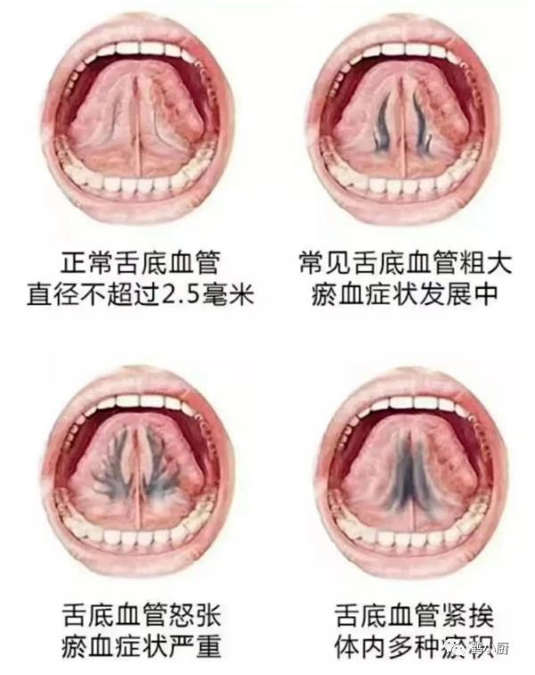 气滞血瘀的舌像2.jpg