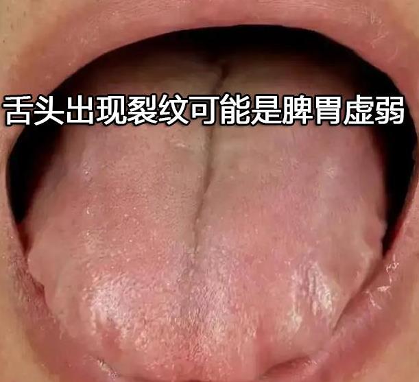 舌头出现裂纹可能是脾胃虚弱.jpg 舌头出现裂纹可能是脾胃虚弱.jpg