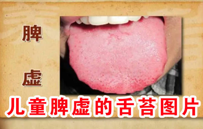 儿童脾虚的舌苔图片.jpg